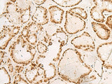 Immunohistochemistry of paraffin-embedded Human thyroid cancer tissue using POM121 Polyclonal Antibody at dilution of 1:40(×200)