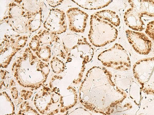 Immunohistochemistry of paraffin-embedded Human thyroid cancer tissue using POM121 Polyclonal Antibody at dilution of 1:40(×200)