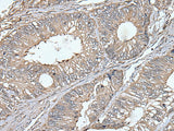 Immunohistochemistry of paraffin-embedded Human colorectal cancer tissue using UNC13B Polyclonal Antibody at dilution of 1:40(×200)