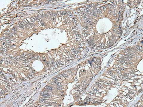 Immunohistochemistry of paraffin-embedded Human colorectal cancer tissue using UNC13B Polyclonal Antibody at dilution of 1:40(×200)