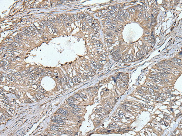 Immunohistochemistry of paraffin-embedded Human colorectal cancer tissue using UNC13B Polyclonal Antibody at dilution of 1:40(×200)