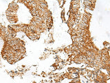 Immunohistochemistry of paraffin-embedded Human colorectal cancer tissue using GPR119 Polyclonal Antibody at dilution of 1:45(×200)