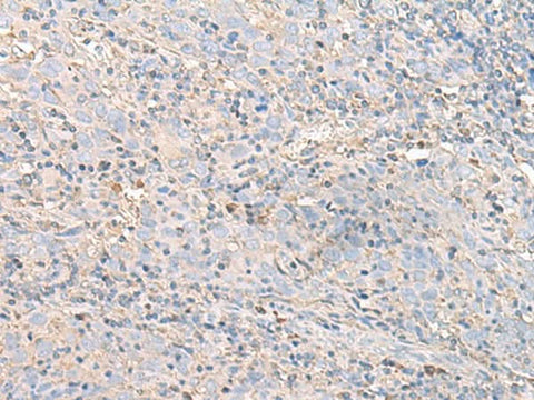 Immunohistochemistry of paraffin-embedded Human cervical cancer tissue using IGHA1 Polyclonal Antibody at dilution of 1:50(×200)