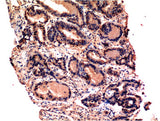 Immunohistochemistry of paraffin-embedded Human prostate tissue using CASP3 Monoclonal Antibody at dilution of 1:200.