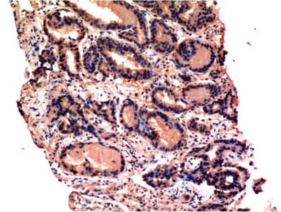 Immunohistochemistry of paraffin-embedded Human prostate tissue using CASP3 Monoclonal Antibody at dilution of 1:200.