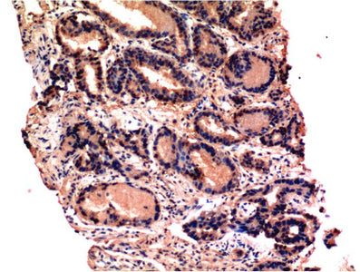 Immunohistochemistry of paraffin-embedded Human prostate tissue using CASP3 Monoclonal Antibody at dilution of 1:200.