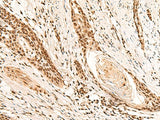 Immunohistochemistry of paraffin-embedded Human esophagus cancer tissue using RMND5B Polyclonal Antibody at dilution of 1:50(×200)