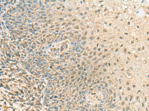 Immunohistochemistry of paraffin-embedded Human tonsil tissue using PPCDC Polyclonal Antibody at dilution of 1:55(×200)