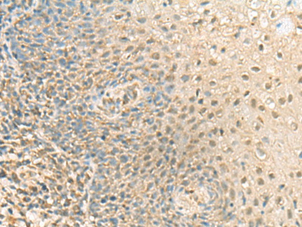 Immunohistochemistry of paraffin-embedded Human tonsil tissue using PPCDC Polyclonal Antibody at dilution of 1:55(×200)