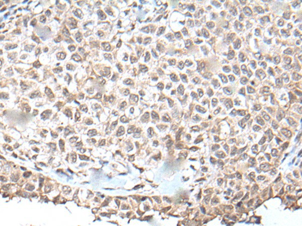 Immunohistochemistry of paraffin-embedded Human ovarian cancer tissue using UBN1 Polyclonal Antibody at dilution of 1:130(×200)
