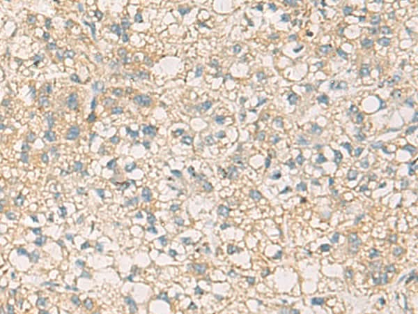 Immunohistochemistry of paraffin-embedded Human liver cancer tissue using STX6 Polyclonal Antibody at dilution of 1:45(×200)