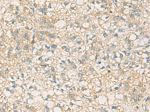 Immunohistochemistry of paraffin-embedded Human liver cancer tissue using STX6 Polyclonal Antibody at dilution of 1:45(×200)