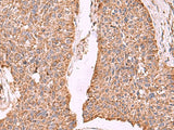 Immunohistochemistry of paraffin-embedded Human esophagus cancer tissue using PER3 Polyclonal Antibody at dilution of 1:55(×200)