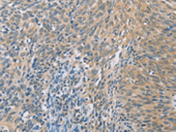 Immunohistochemistry of paraffin-embedded Human cervical cancer tissue using ZHX3 Polyclonal Antibody at dilution of 1:100(×200)