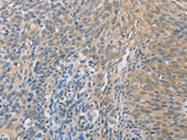 Immunohistochemistry of paraffin-embedded Human cervical cancer tissue using ZHX3 Polyclonal Antibody at dilution of 1:100(×200)