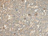 Immunohistochemistry of paraffin-embedded Human liver cancer tissue using CA11 Polyclonal Antibody at dilution of 1:45(×200)