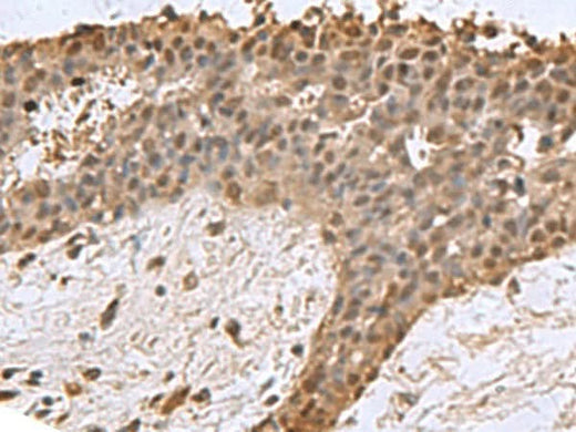 Immunohistochemistry of paraffin-embedded Human breast cancer tissue using DCTPP1 Polyclonal Antibody at dilution of 1:85(×200)