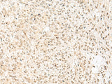 Immunohistochemistry of paraffin-embedded Human liver cancer tissue using RBX1 Polyclonal Antibody at dilution of 1:50(×200)