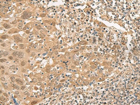 Immunohistochemistry of paraffin-embedded Human cervical cancer tissue using ISCU Polyclonal Antibody at dilution of 1:45(×200)