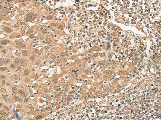 Immunohistochemistry of paraffin-embedded Human cervical cancer tissue using ISCU Polyclonal Antibody at dilution of 1:45(×200)