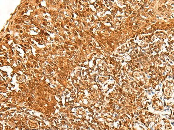 Immunohistochemistry of paraffin-embedded Human tonsil tissue using ADRM1 Polyclonal Antibody at dilution of 1:30(×200)