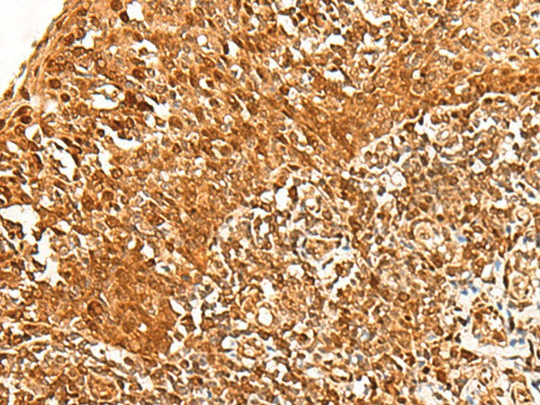 Immunohistochemistry of paraffin-embedded Human tonsil tissue using ADRM1 Polyclonal Antibody at dilution of 1:30(×200)