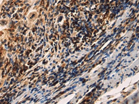 Immunohistochemistry of paraffin-embedded Human esophagus cancer tissue using IRAK2 Polyclonal Antibody at dilution of 1:60(×200)