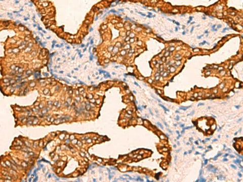 Immunohistochemistry of paraffin-embedded Human prost at e cancer tissue using CRYM Polyclonal Antibody at dilution of 1:60(×200)