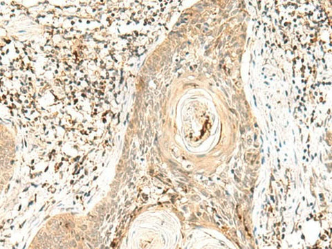 Immunohistochemistry of paraffin-embedded Human esophagus cancer tissue using POLR1E Polyclonal Antibody at dilution of 1:40(×200)