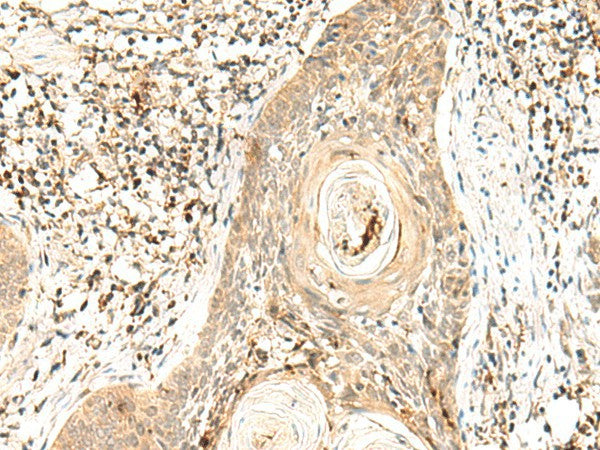 Immunohistochemistry of paraffin-embedded Human esophagus cancer tissue using POLR1E Polyclonal Antibody at dilution of 1:40(×200)