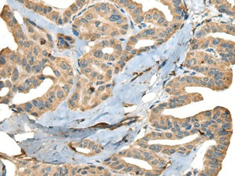 Immunohistochemistry of paraffin-embedded Human thyroid cancer tissue using CDADC1 Polyclonal Antibody at dilution of 1:40(×200)