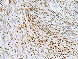 Immunohistochemistry of paraffin-embedded Human lung cancer tissue using CNOT7 Polyclonal Antibody at dilution of 1:55(×200)