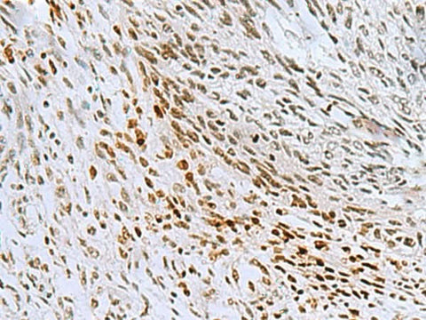 Immunohistochemistry of paraffin-embedded Human lung cancer tissue using CNOT7 Polyclonal Antibody at dilution of 1:55(×200)