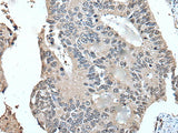 Immunohistochemistry of paraffin-embedded Human colorectal cancer tissue using UFM1 Polyclonal Antibody at dilution of 1:45(×200)