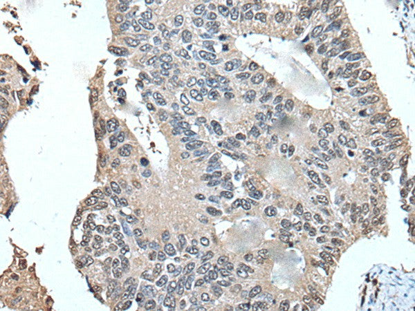 Immunohistochemistry of paraffin-embedded Human colorectal cancer tissue using UFM1 Polyclonal Antibody at dilution of 1:45(×200)