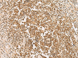 Immunohistochemistry of paraffin-embedded Human prost at e cancer tissue using PAX5 Polyclonal Antibody at dilution of 1:30(×200)