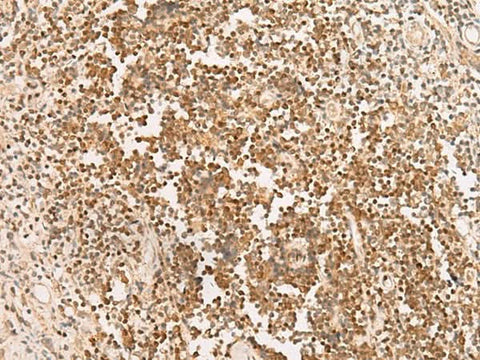 Immunohistochemistry of paraffin-embedded Human prost at e cancer tissue using PAX5 Polyclonal Antibody at dilution of 1:30(×200)