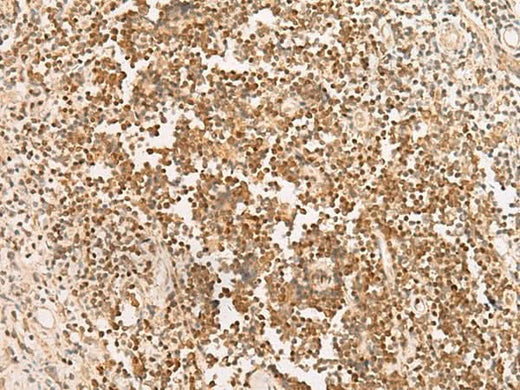 Immunohistochemistry of paraffin-embedded Human prost at e cancer tissue using PAX5 Polyclonal Antibody at dilution of 1:30(×200)