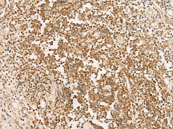 Immunohistochemistry of paraffin-embedded Human prost at e cancer tissue using PAX5 Polyclonal Antibody at dilution of 1:30(×200)