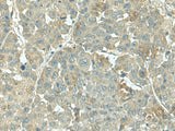 Immunohistochemistry of paraffin-embedded Human liver cancer tissue using KRT36 Polyclonal Antibody at dilution of 1:55(×200)