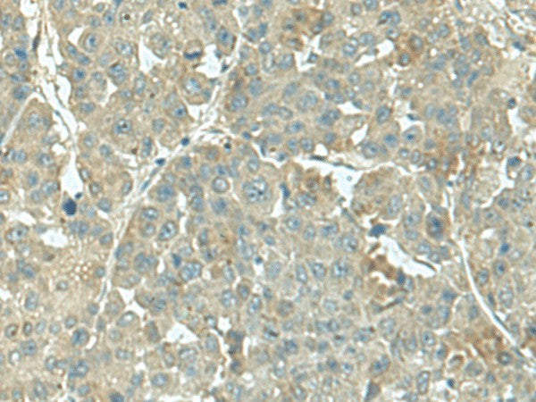 Immunohistochemistry of paraffin-embedded Human liver cancer tissue using KRT36 Polyclonal Antibody at dilution of 1:55(×200)