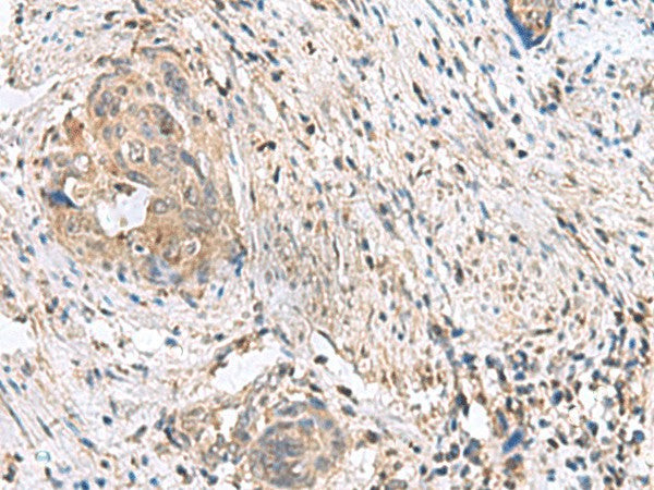 Immunohistochemistry of paraffin-embedded Human cervical cancer tissue using STK32A Polyclonal Antibody at dilution of 1:90(×200)