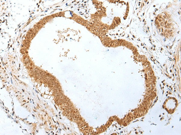 Immunohistochemistry of paraffin-embedded Human gastric cancer tissue using PEG3 Polyclonal Antibody at dilution of 1:45(×200)