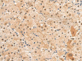 Immunohistochemistry of paraffin-embedded Human liver cancer tissue using HEBP2 Polyclonal Antibody at dilution of 1:60(×200)