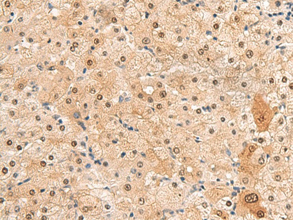 Immunohistochemistry of paraffin-embedded Human liver cancer tissue using HEBP2 Polyclonal Antibody at dilution of 1:60(×200)