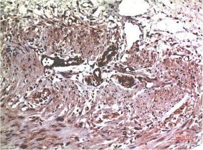 Immunohistochemistry of paraffin-embedded Human colon carcinoma tissue using MMP2 Monoclonal Antibody at dilution of 1:200.