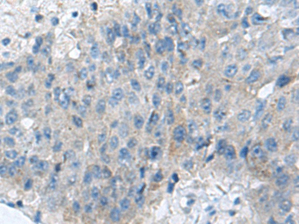 Immunohistochemistry of paraffin-embedded Human liver cancer tissue using KIAA0556 Polyclonal Antibody at dilution of 1:70(×200)