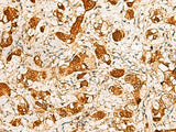 Immunohistochemistry of paraffin-embedded Human liver cancer tissue using C11orf54 Polyclonal Antibody at dilution of 1:50(×200)