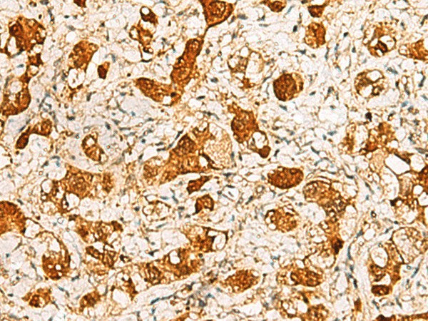 Immunohistochemistry of paraffin-embedded Human liver cancer tissue using C11orf54 Polyclonal Antibody at dilution of 1:50(×200)