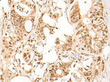 Immunohistochemistry of paraffin-embedded Human colorectal cancer tissue using ARID1B Polyclonal Antibody at dilution of 1:40(×200)